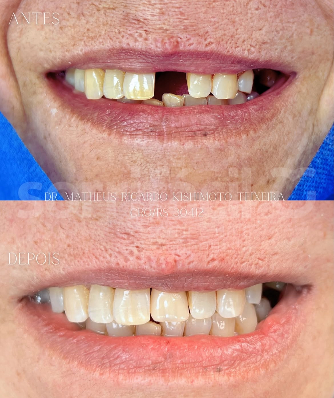 Antes e depois do tratamento