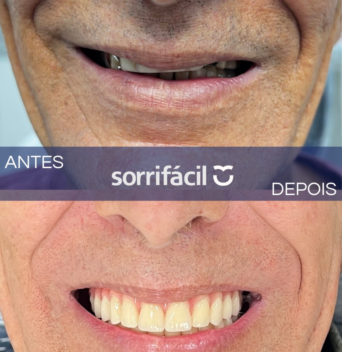 Antes e depois do tratamento